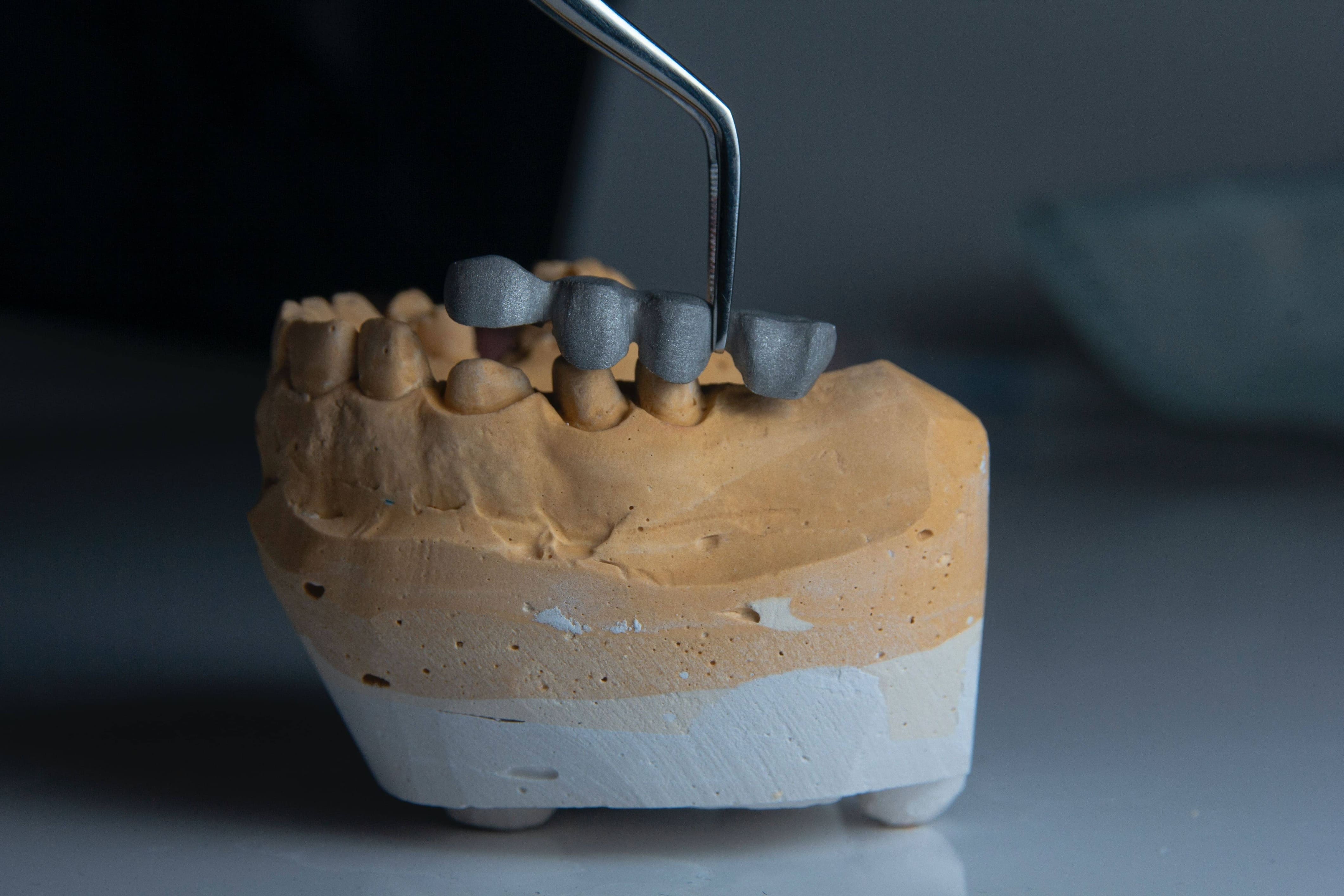 Impression 3D et prothses : amliorer la qualit de vie